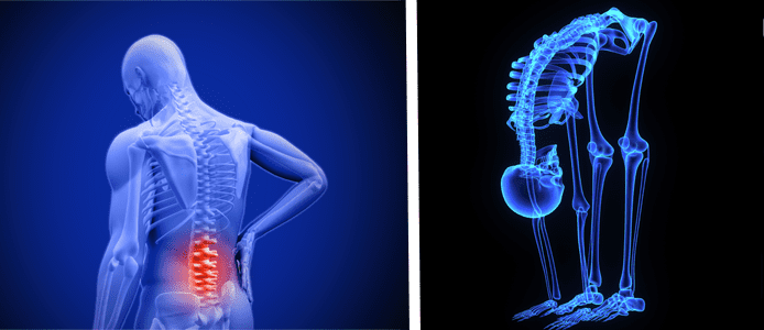 Graphic depicting an x-ray with the lumbar region in red and a graphic depicting a skeleton exercising Graphic depicting an x-ray with the lumbar region in red and a graphic depicting a skeleton exercising